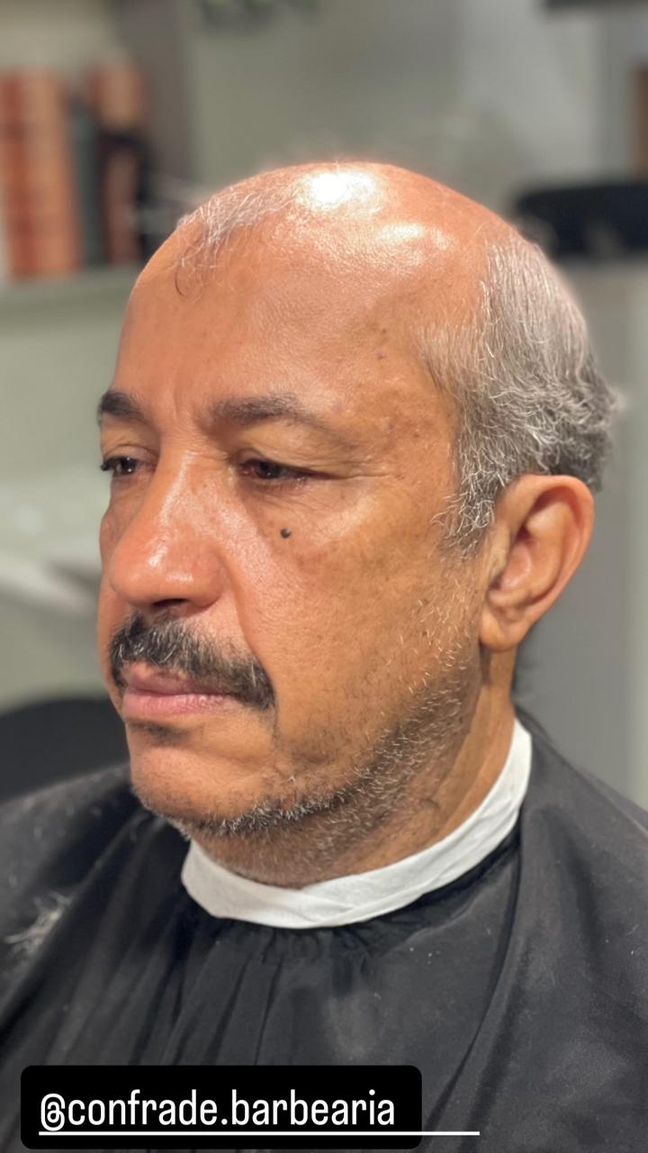 Prótese capilar imperceptível